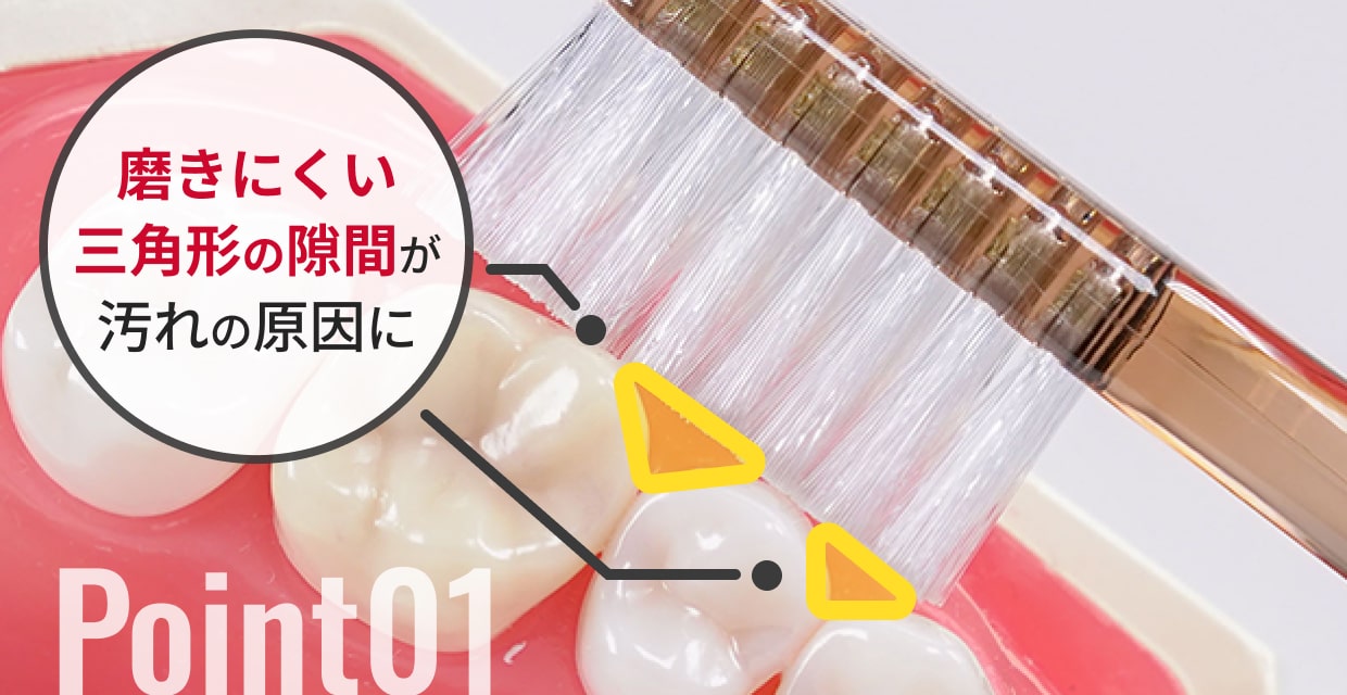磨きにくい三角形の隙間が汚れの原因に